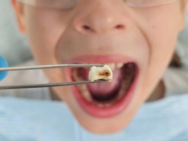 Best Emergency Dentist for Lost Fillings or Crowns in Olympia Fields, IL